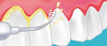 Descubriendo los beneficios de los aparatos ultrasónicos dentales para su salud oral